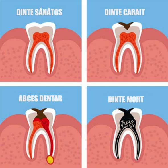 Abces dentar grafic