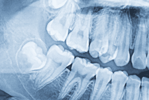 Radiografie masea de minte